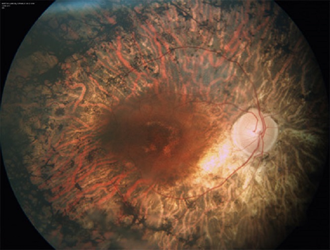 30.000 euros para la investigación en distrofias hereditarias de la retina