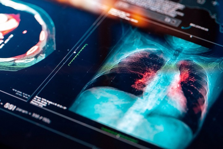 Cáncer: 19 meses de retraso en el acceso a los medicamentos innovadores