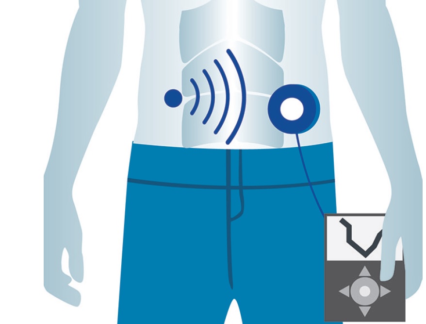 Claves para un acceso equitativo a las nuevas tecnologías en la diabetes