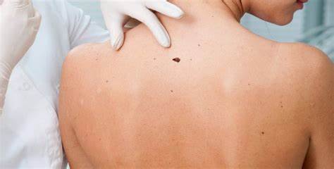 Aumenta la incidencia del melanoma cutáneo en España