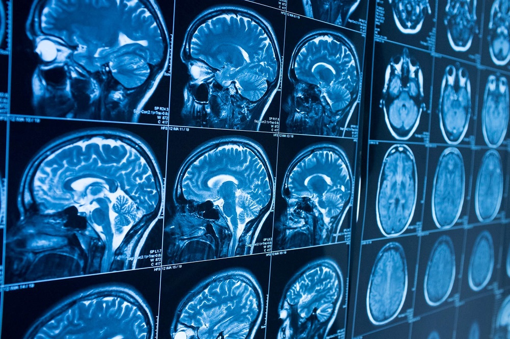 La prevalencia de las enfermedades neurológicas en España es un 18% superior respecto a la media mundial