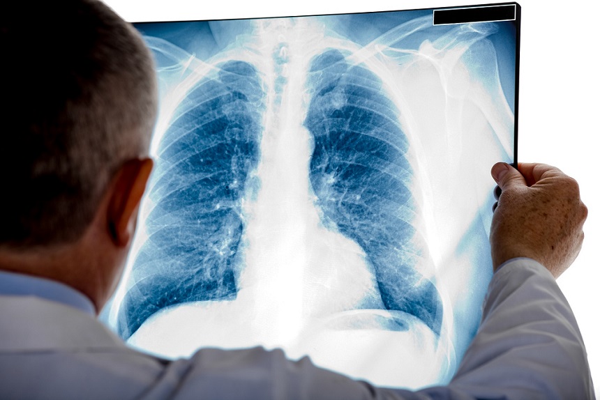 Web con toda la información sobre el cáncer de pulmón