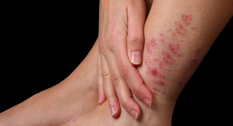Los avances terapéuticos en psoriasis «permiten aspirar a un control más eficaz, sostenido y cómodo» para los pacientes