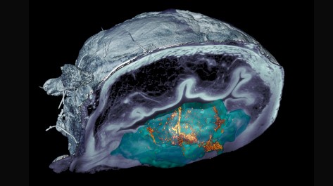 Cáncer de vejiga: nanorrobots consiguen reducir en un 90% el tamaño del tumor