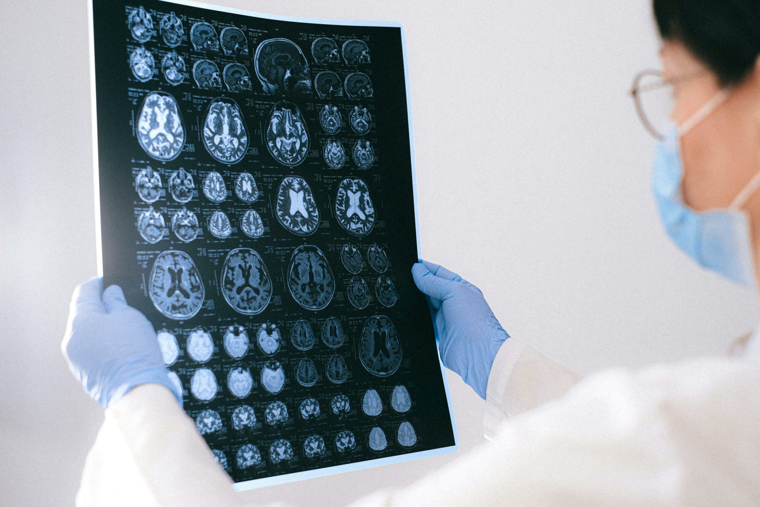 Alta prevalencia de cambios cerebrales ocultos en personas con enfermedades cardíacas