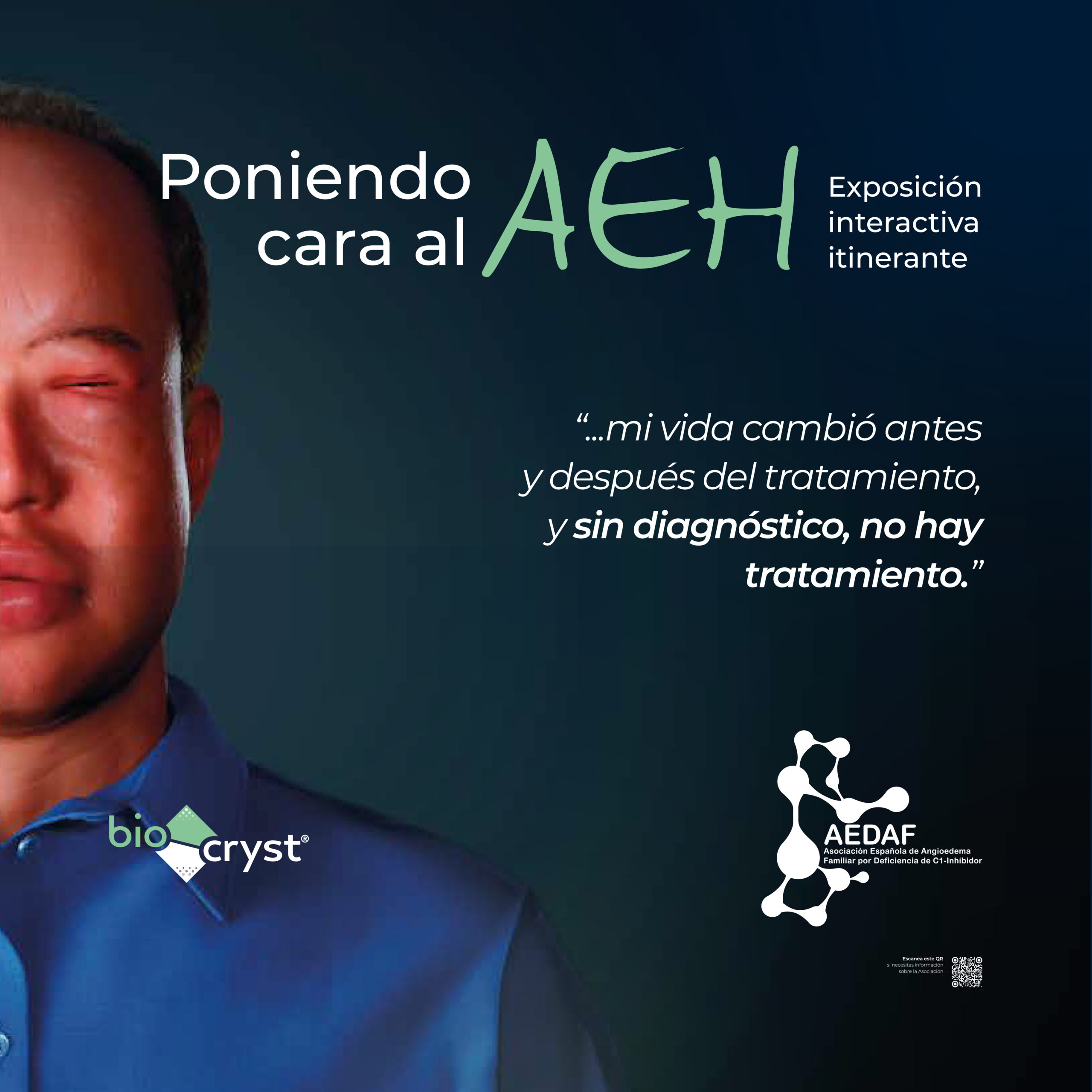 Arranca una exposición para concienciar sobre el impacto del angioedema hereditario