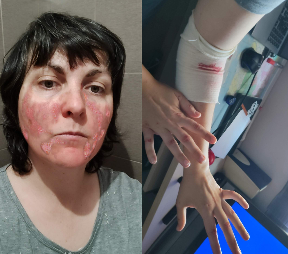 Simulación de dermatitis atópica