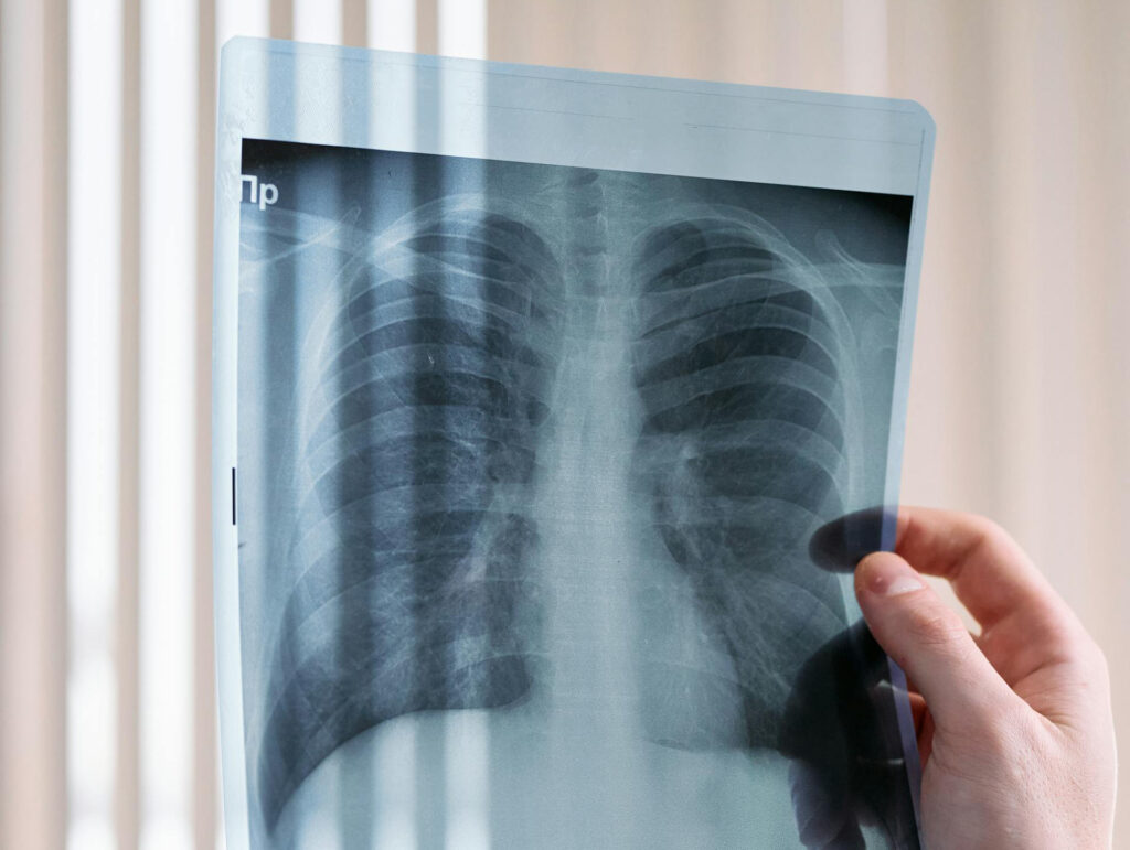 pulmones y bronquiectasias