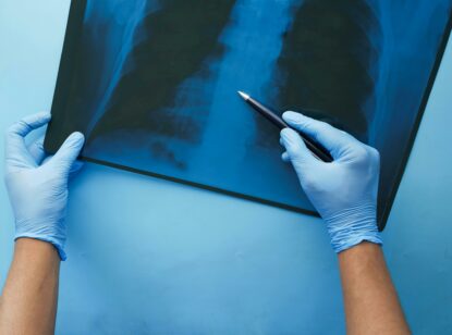 El 75% de las fracturas vertebrales osteoporóticas no se diagnostican por la falta de síntomas claros