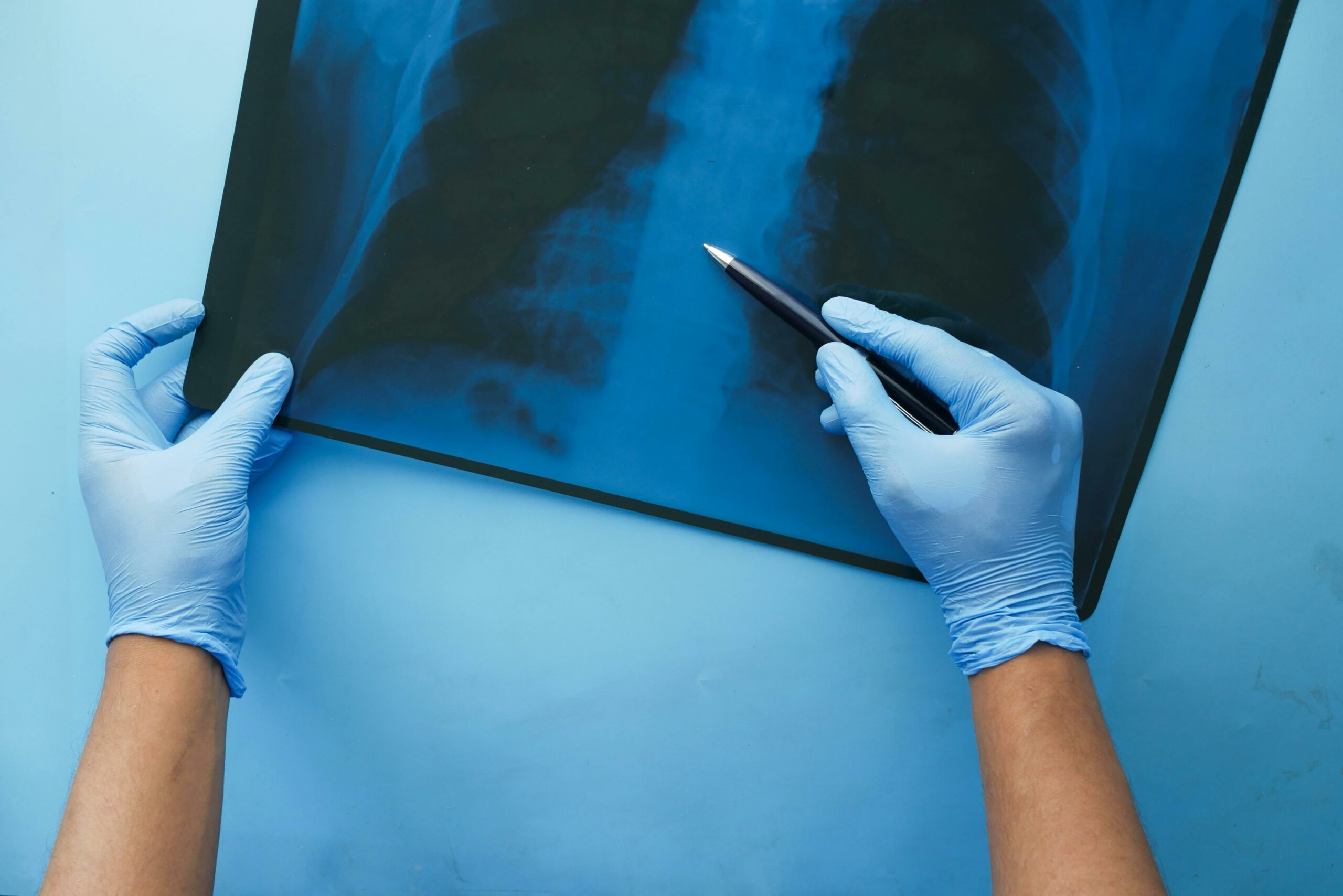 El 75% de las fracturas vertebrales osteoporóticas no se diagnostican por la falta de síntomas claros