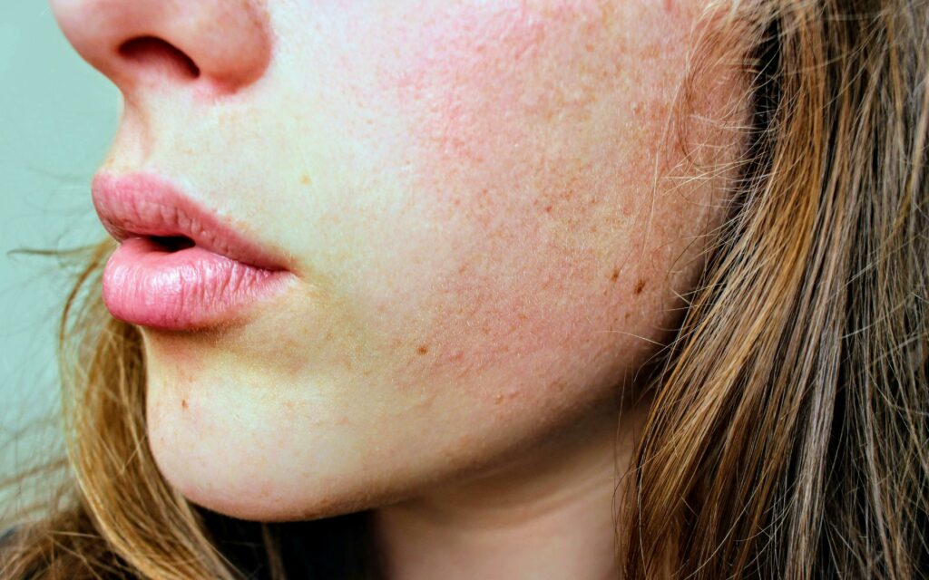 herpes labial